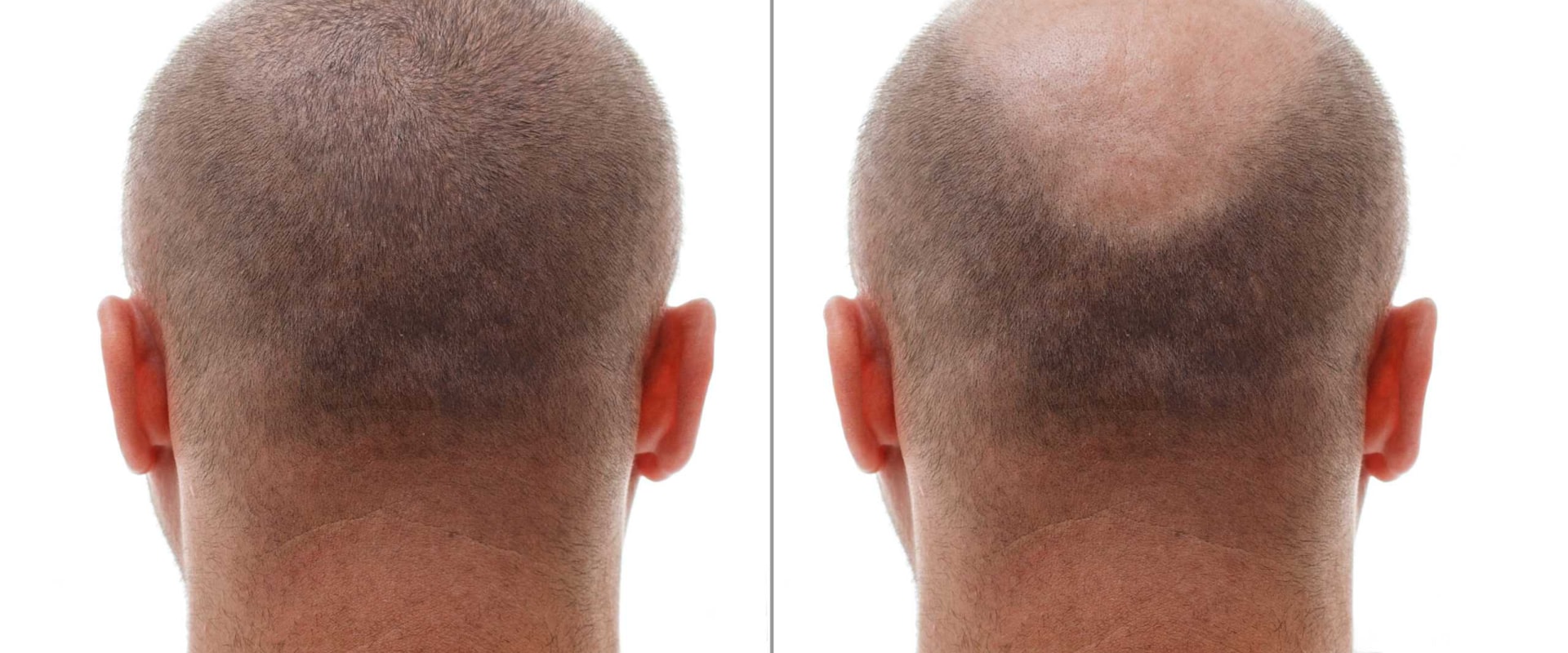 Are hair transplants guaranteed to work?