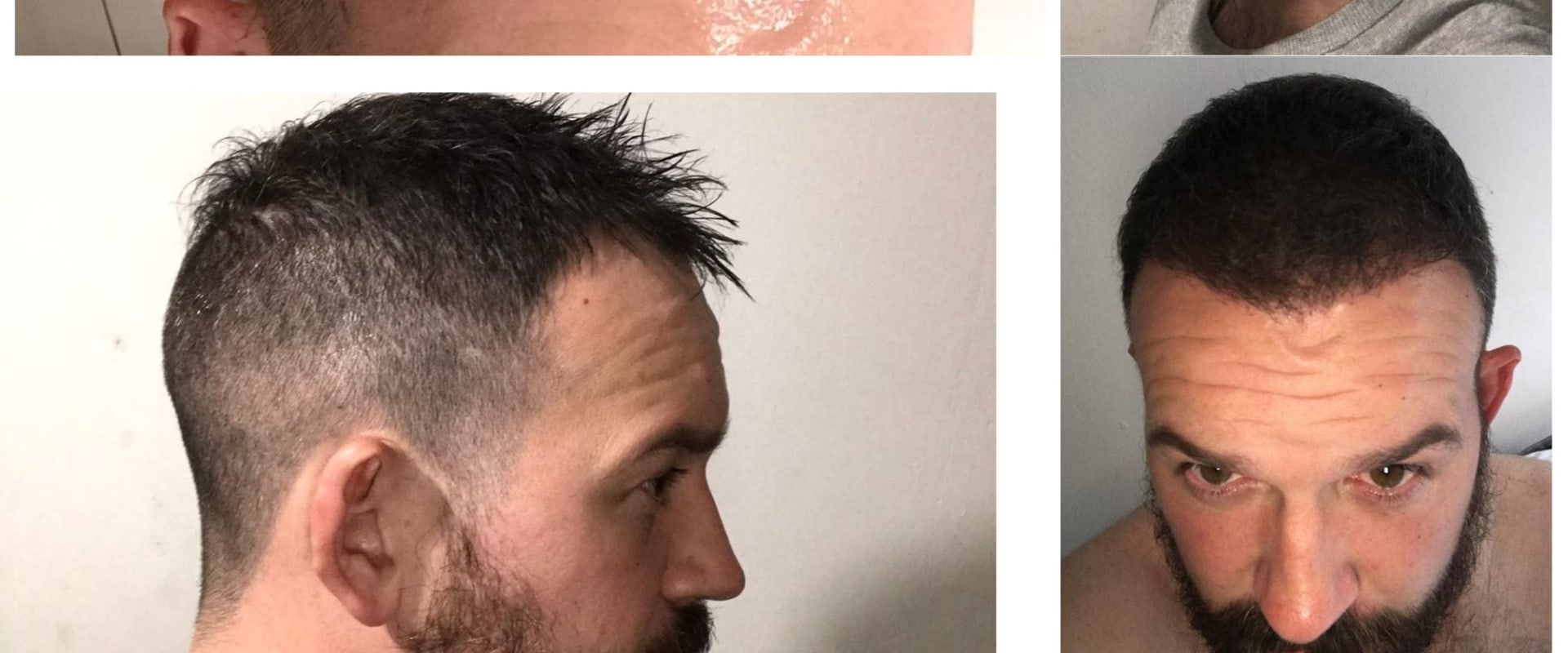 Is a Hair Transplant Permanent? A Comprehensive Guide