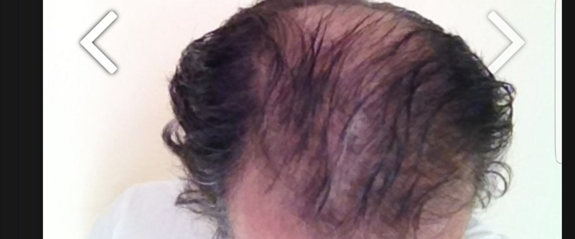 Is Hair Transplant an Illusion?
