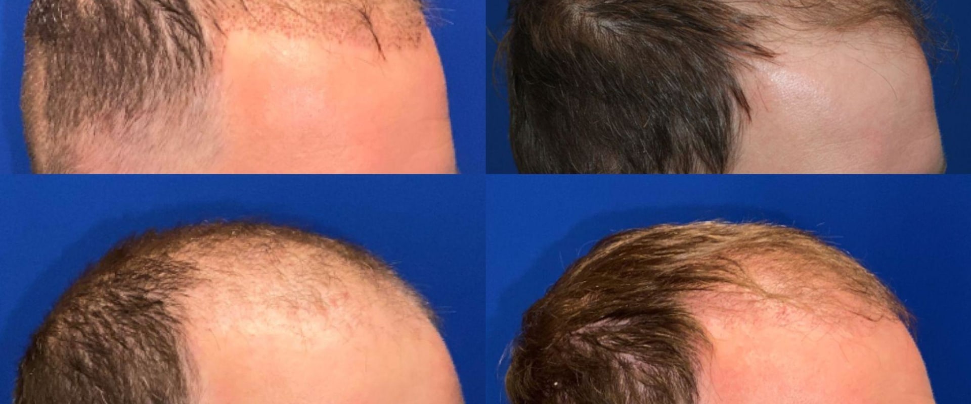 Does a Hair Transplant Last Forever?