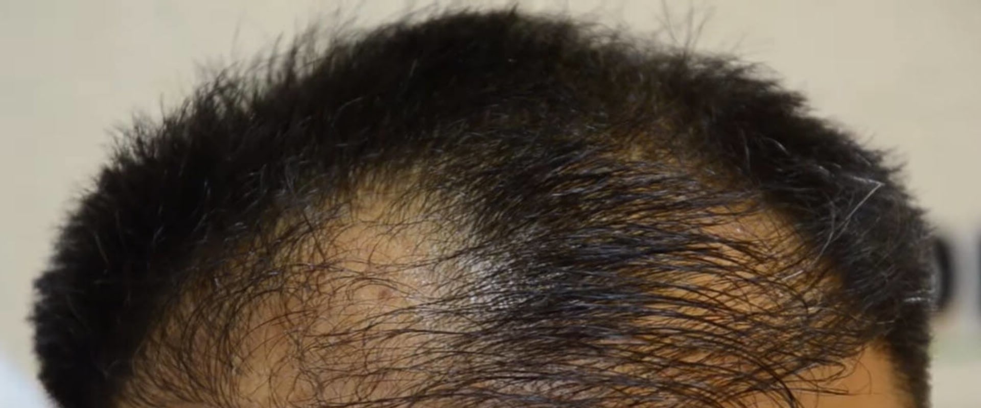 How to Identify a Failed Hair Transplant