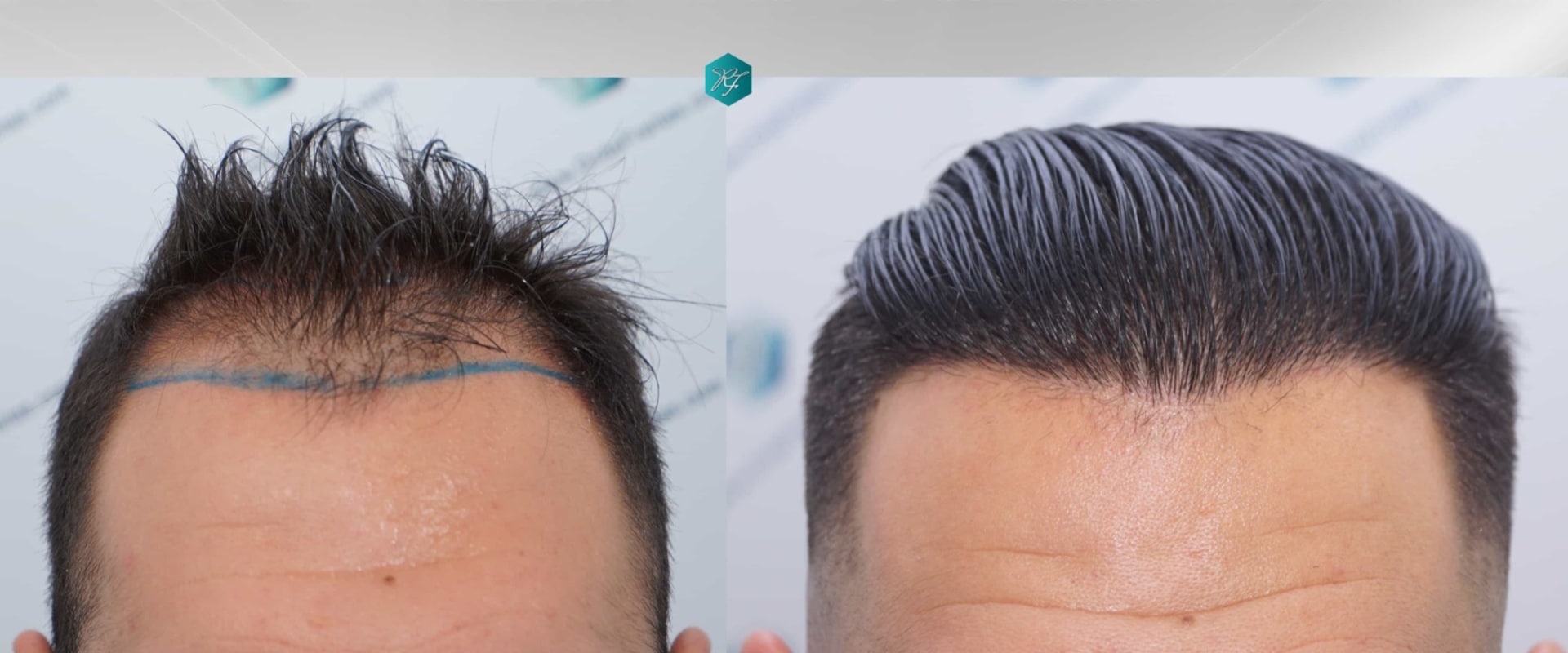 Which type of hair transplant is best?
