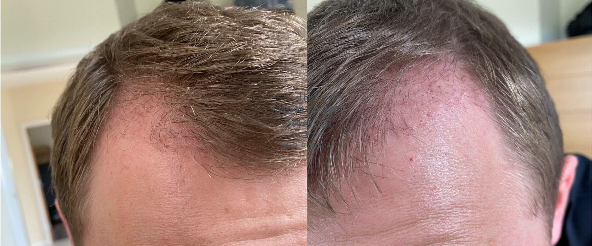 How Long Does a Hair Transplant Last?