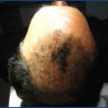 Can hair transplant cause cancer?
