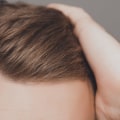 What are the Disadvantages of Hair Transplant Surgery?