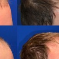 Does a Hair Transplant Last Forever?