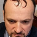 Does a Hair Transplant Keep Growing?