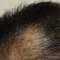 What is the Success Rate of Hair Grafts After a Hair Transplant?