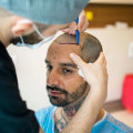 How much does a decent hair transplant cost?