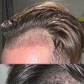 Does transplanted hair fall out?
