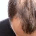 Do Hair Transplants Work 100%? A Comprehensive Guide