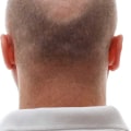 Are Hair Transplants 100% Successful? An Expert's Perspective