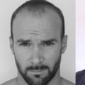 Does transplanted hair thicken over time?