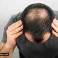 Everything You Need to Know About Hair Transplant Surgery
