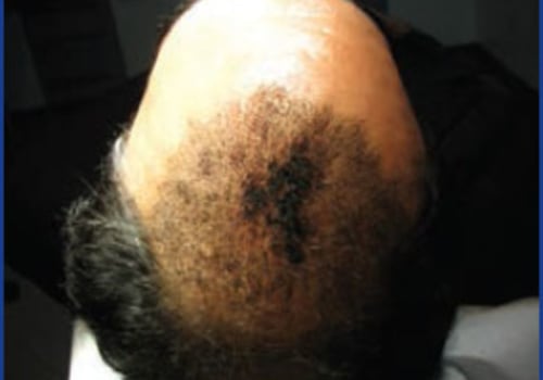 Can hair transplant cause cancer?