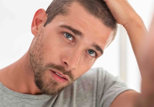 The Pros and Cons of Hair Transplant Surgery