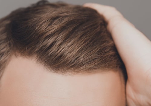 What are the Disadvantages of Hair Transplant Surgery?