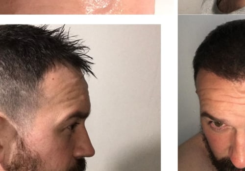 Is a Hair Transplant Permanent? A Comprehensive Guide