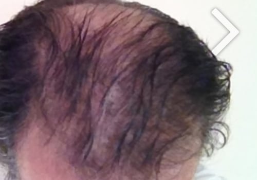 Is Hair Transplant an Illusion?