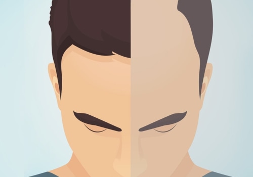 What is the Success Rate of Hair Transplant Surgery?