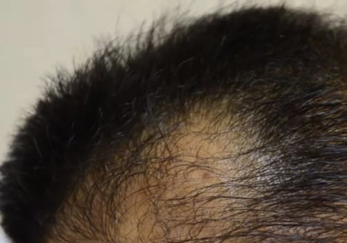 Do Most Hair Transplants Fail? An Expert's Perspective