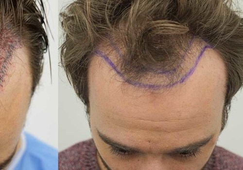 What is the Success Rate of Hair Transplant Surgery?