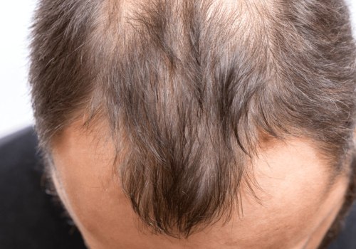 Do hair transplants work 100%?