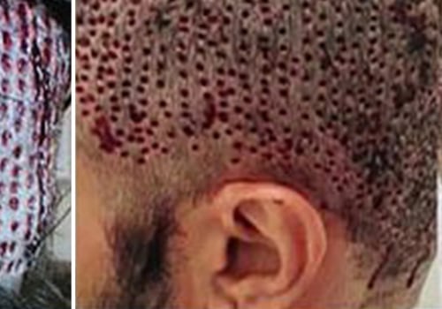 Is it risky to have hair transplant?