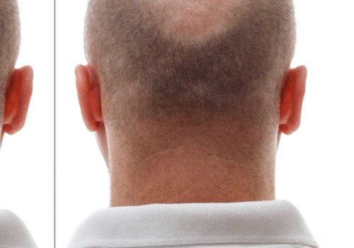 Are Hair Transplants 100% Successful? An Expert's Perspective
