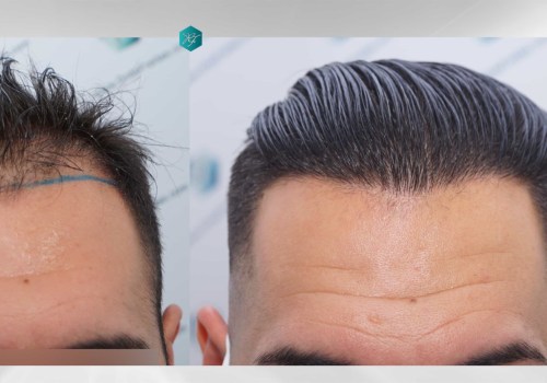 Which Hair Transplant is Best for You?