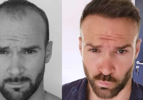 Does transplanted hair thicken over time?